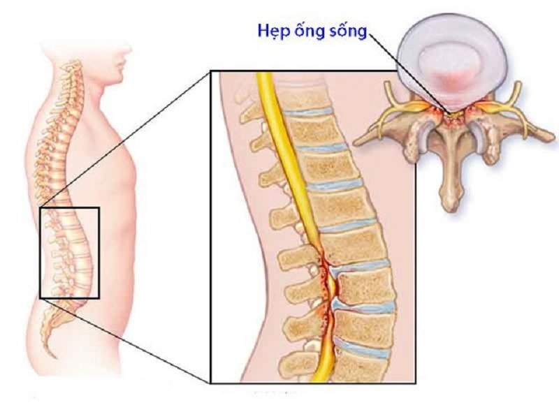 Tình trạng hẹp ống sống cần được thăm khám và điều trị từ sớm